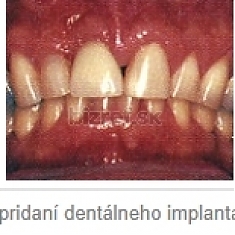Implantológia